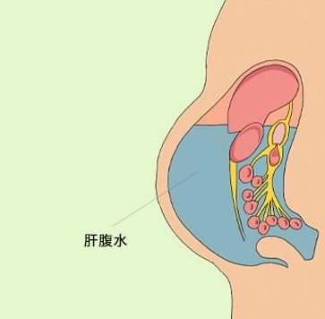 肝腹水饮食注意什么_肝腹水的饮食指导_肝腹水应注意事项