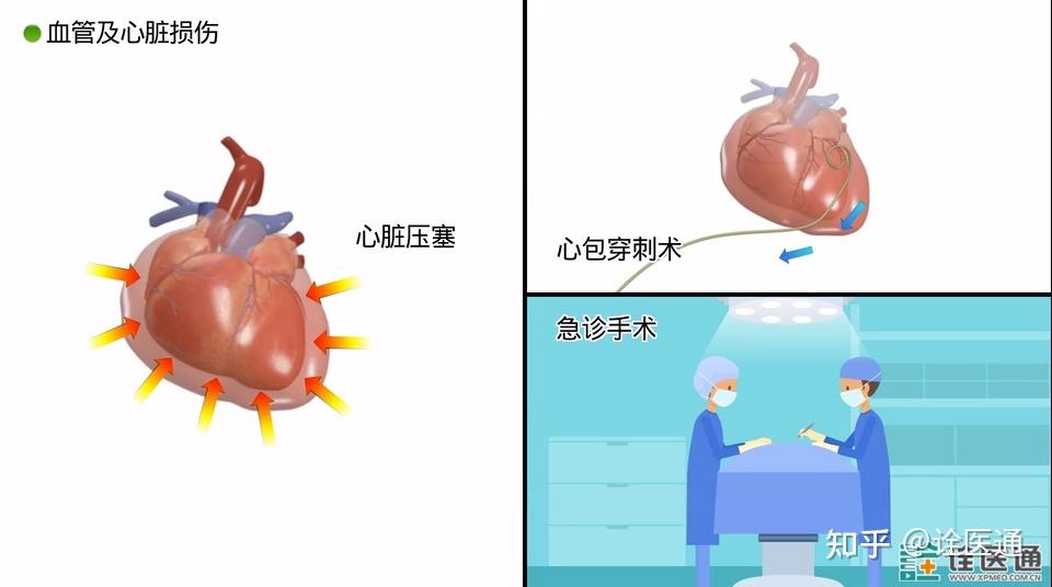 介入治疗心梗过程_心梗介入治疗并发症_心肌梗塞介入手术并发症