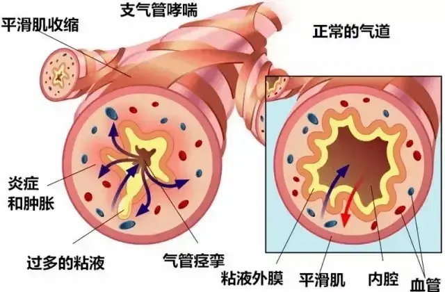 中国哮喘患者_哮喘病运动员名单_中国有哮喘的运动员