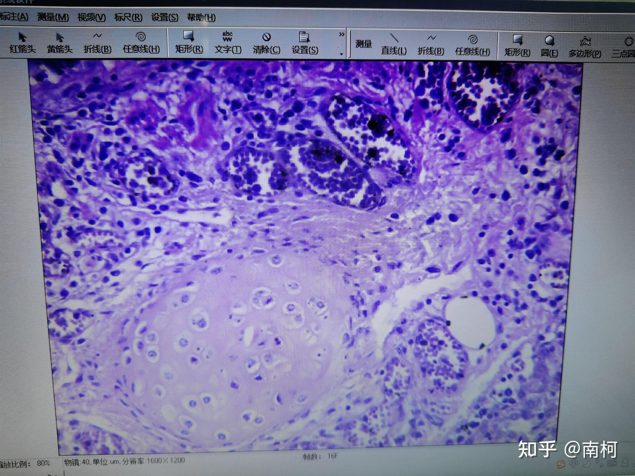 肝硬化胃溃疡吃什么药最好_肝硬化伴随胃溃疡中医治疗_肝硬化胃溃疡能治愈吗