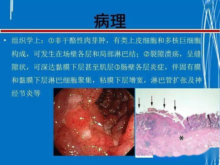 婴儿克丁病图片_克罗恩病(cd)_课罗恩病