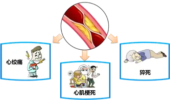 冠心病评估量表_冠心病护理评估表样本_冠心病护理评估单