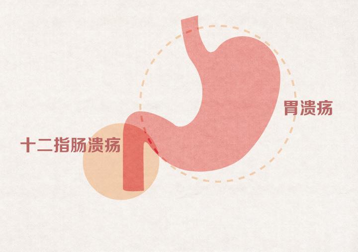 消化性溃疡患者护理-消化性溃疡怎么办？饮食、生活、检查一个都不能少