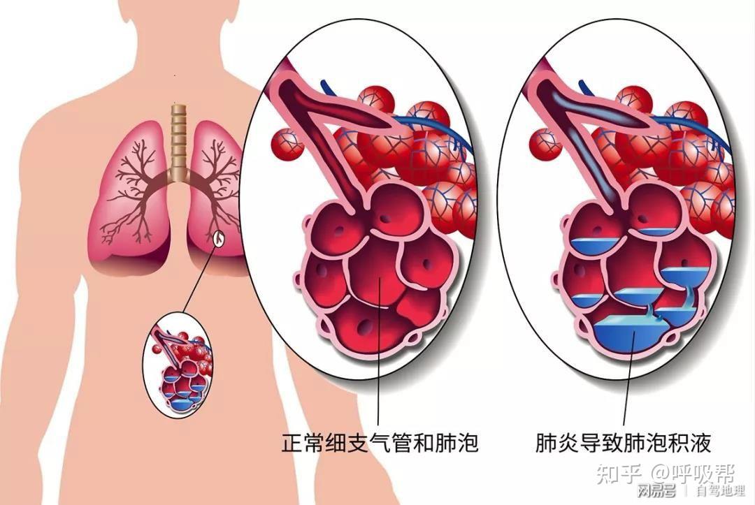 呼吸衰竭定义和分类_什么是呼吸衰竭分型_呼吸衰竭的定义及分型