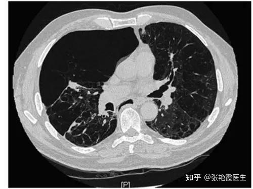 气管炎支气管炎怎么办_支气管炎治疗方法_炎症支气管炎