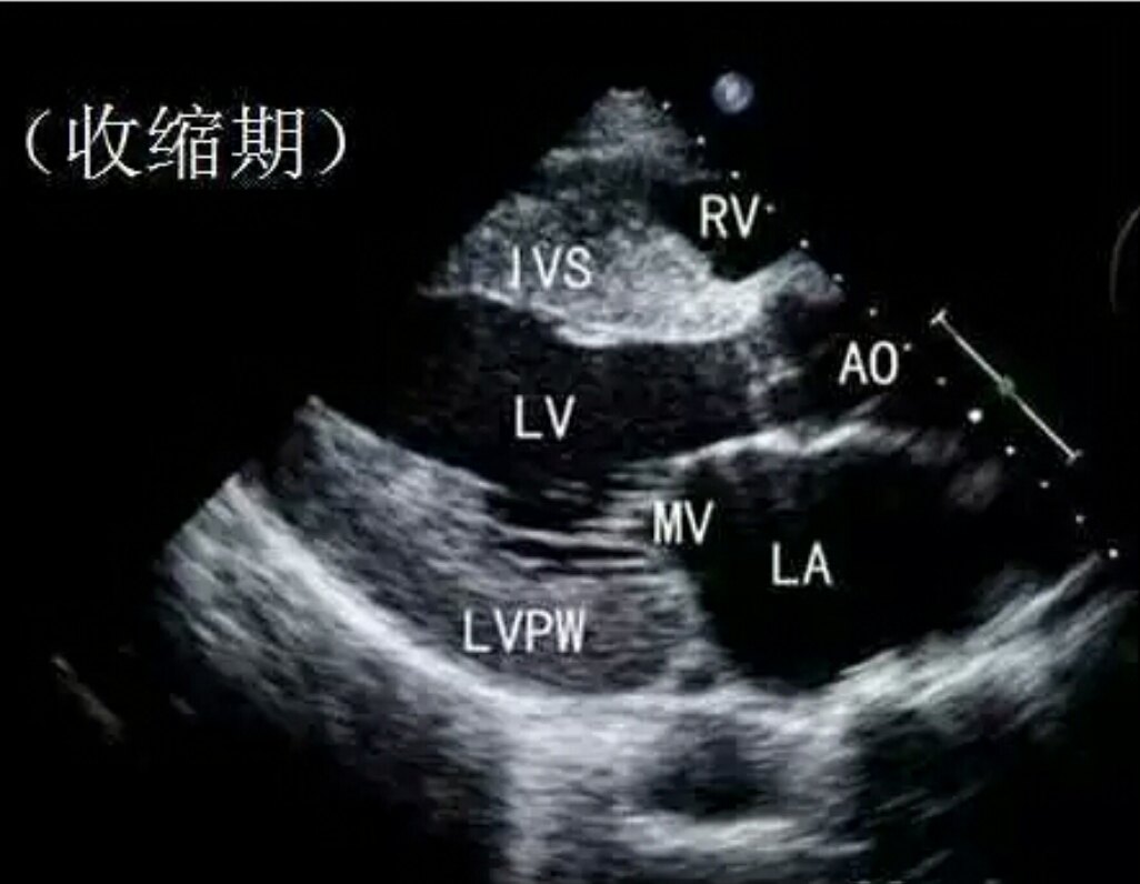 心肌梗塞介入手术并发症_心梗介入治疗并发症_治疗心梗介入性手术复杂