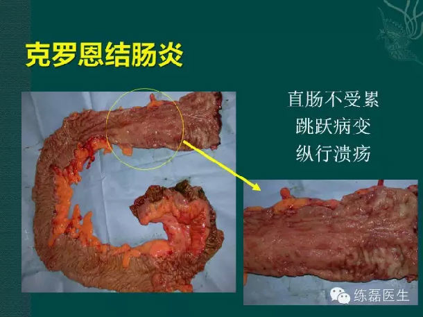 克罗恩氏病的饮食_scd饮食克罗恩_克罗恩病食谱大全