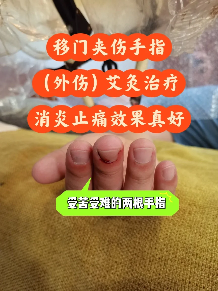 胃病艾灸的好处与功效_患者胃病经验交流艾灸治疗方案_胃病艾灸患者经验交流