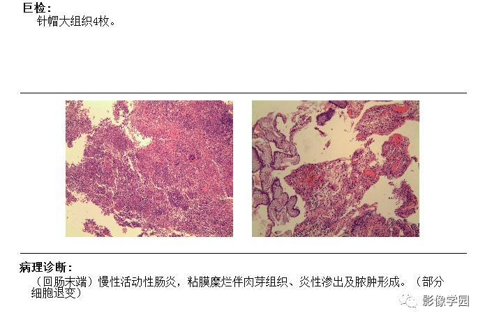 罗克恩病怎么确诊_克罗恩怎么确诊_罗恩克病