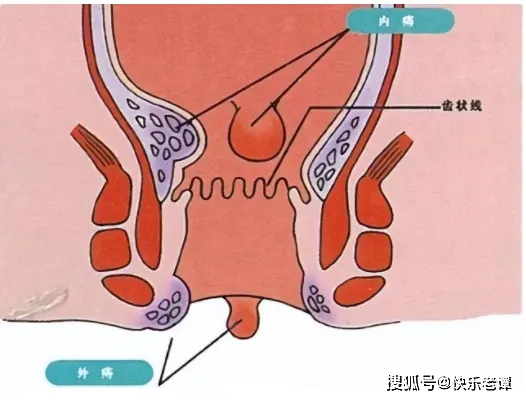 肛瘘手术住院时间_肛瘘手术住院几天可以做手术_住院手术肛瘘时间多长