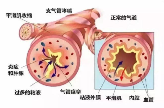 患哮喘的明星_哪个明星孩子有哮喘_有哮喘的名星