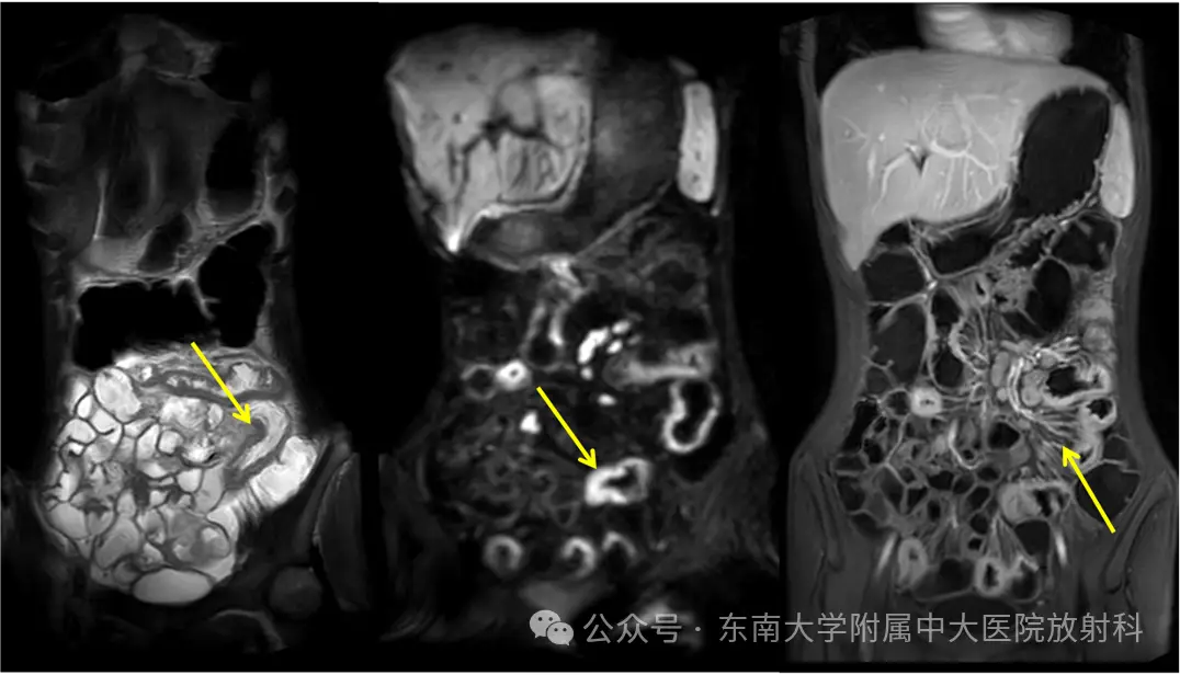 罗克恩病早期症状_克罗恩并发症_罗克罗恩病的特征性体征