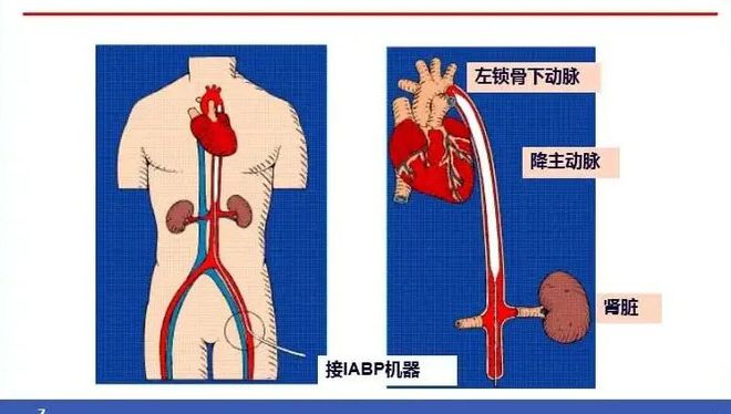 治疗心梗介入性手术复杂_心肌梗塞介入手术并发症_心梗介入治疗并发症