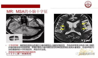 多系统萎缩最后怎么死,疾病进展与死亡原因探析